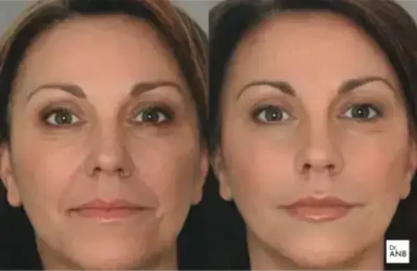 Gençlik ve Nem Uygulamaları before-after 1