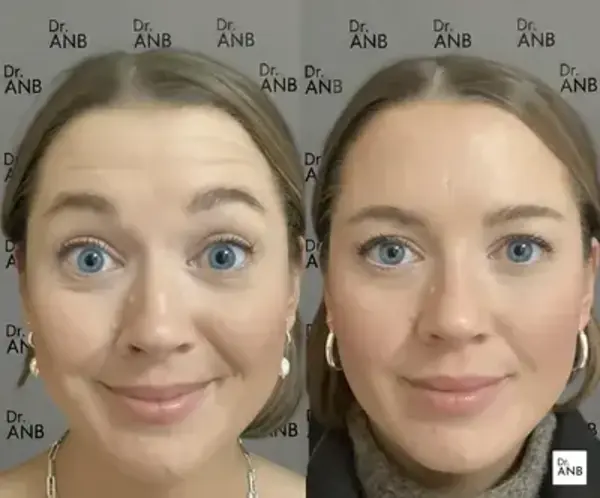 Kırışıklık ve Mimik Uygulamaları before-after 1