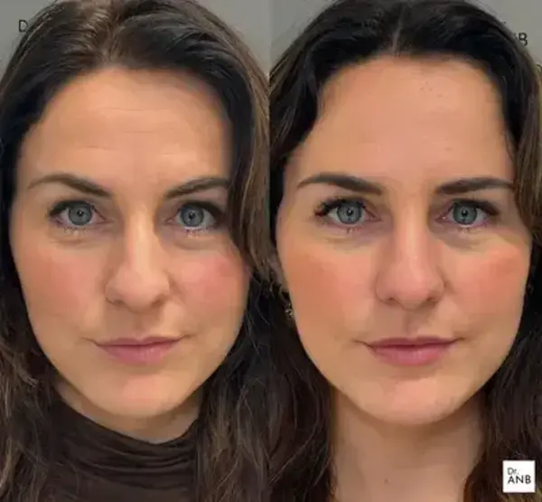 Kırışıklık ve Mimik Uygulamaları before-after 2