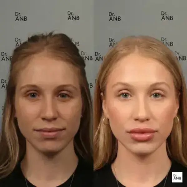 Doku ve Form Uygulamaları before-after 1